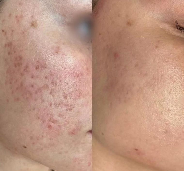 Active acne and post inflammatory marks, before and after at Skin&Co Mississauga