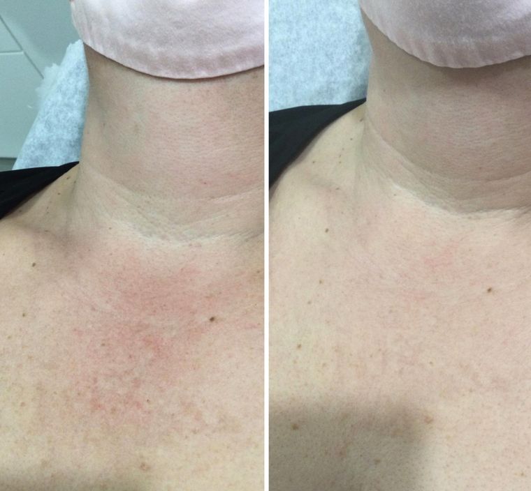 Tone and texture, neck and chest, before and after at Skin&Co Mississauga