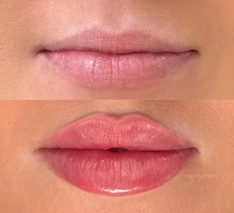 Lip volume and definition, before and after at Skin&Co Mississauga