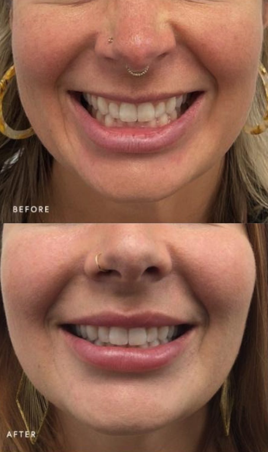Jawline and under chin profile, before and after at Skin&Co Mississauga